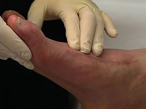 Pictures Of Diabetes Foot Problems
